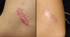 Remover-queloides