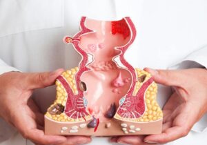 canal-anal-cancer-R6t6u7WAycNzPzsEZdVOwwI-758x531@abc